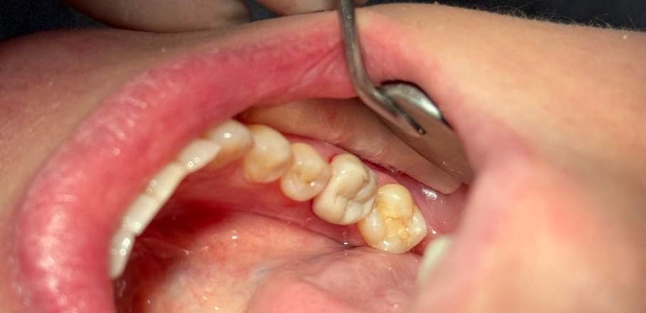 Coroa dentária
