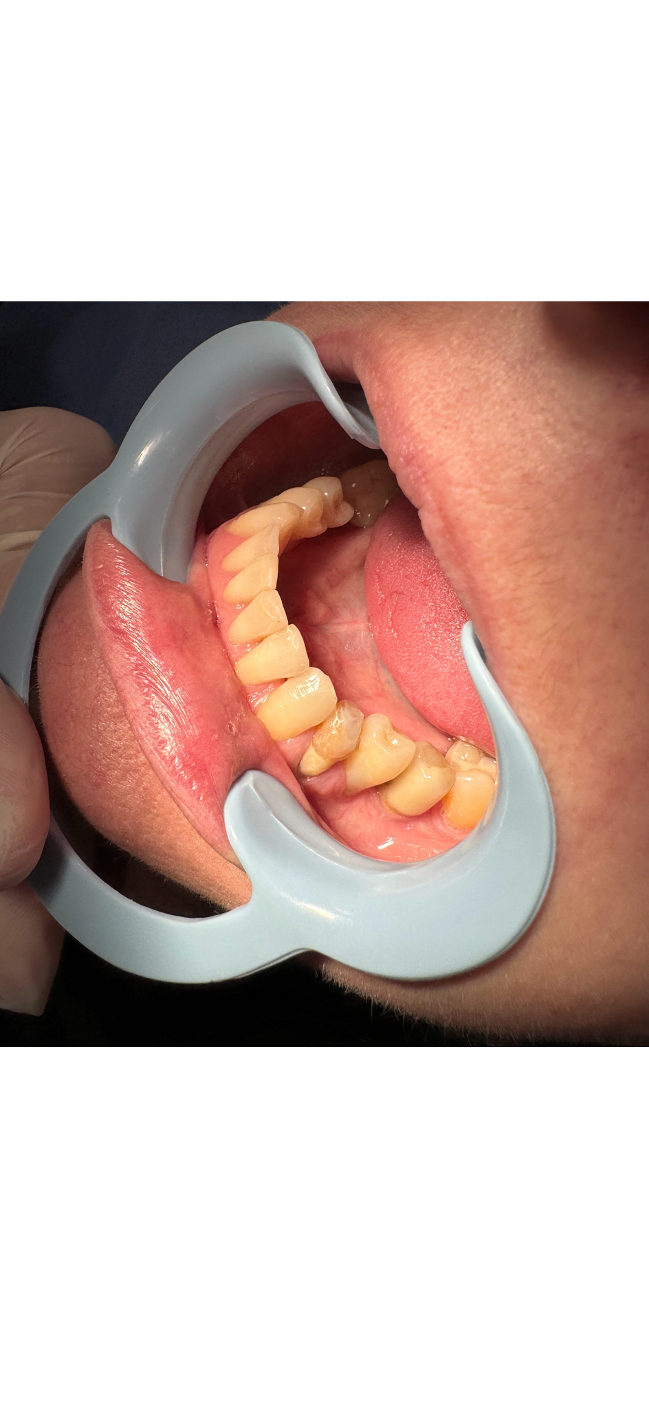 Coroa dentária
