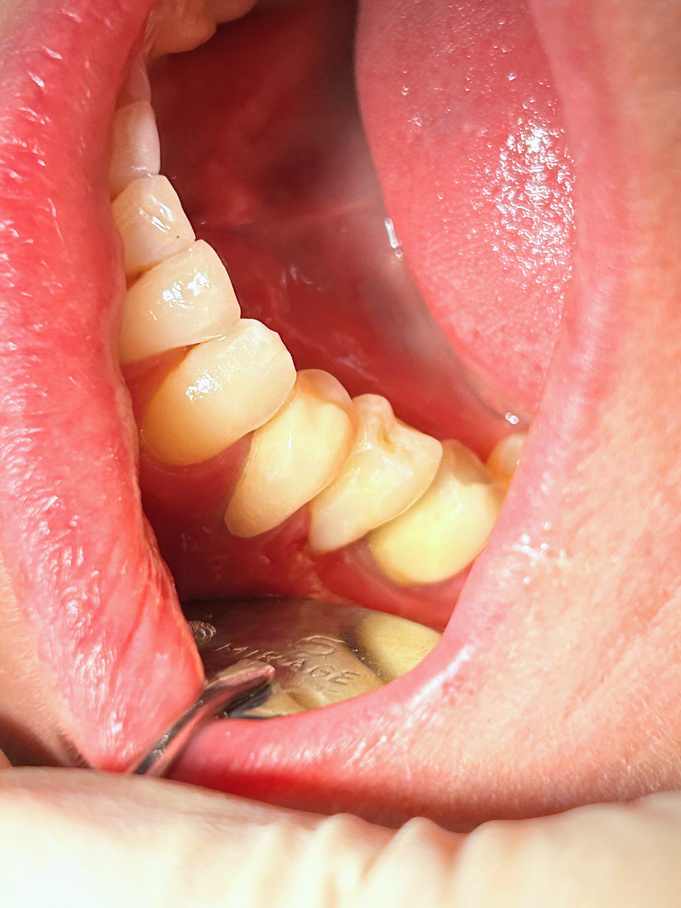 Coroa dentária